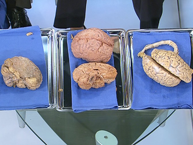 From left to right: A healthy brain, a brain after a hemorrhagic stroke and a brain after a major stroke in the right hemisphere