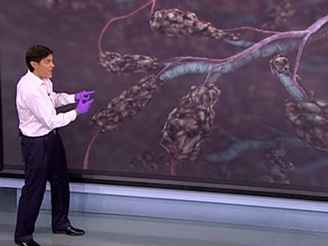 Dr. Oz shows how smoking can damage the lungs.