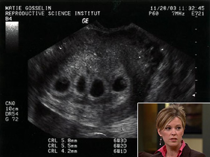 Kate says she was shocked by her ultrasound.