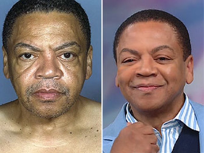 Reggie Wells before and after plastic surgery