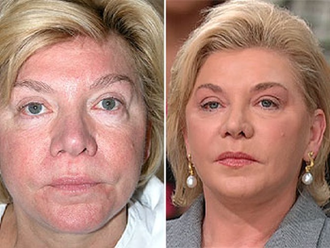 Terry before and after fat injections to remove bags under her eyes