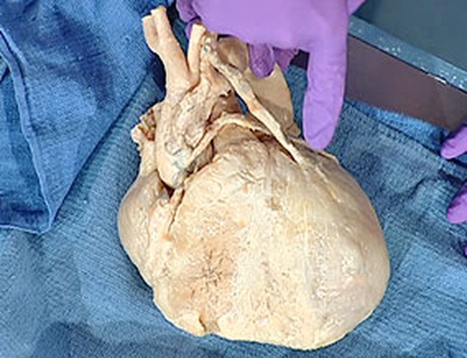 Heart after a bypass surgery