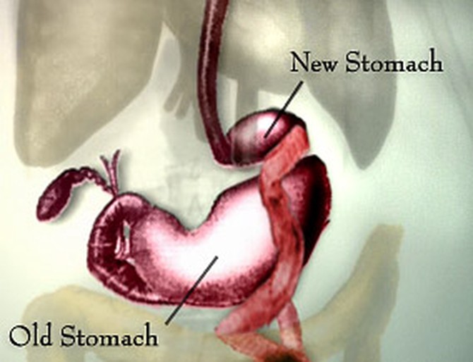 The old stomach and the new stomach