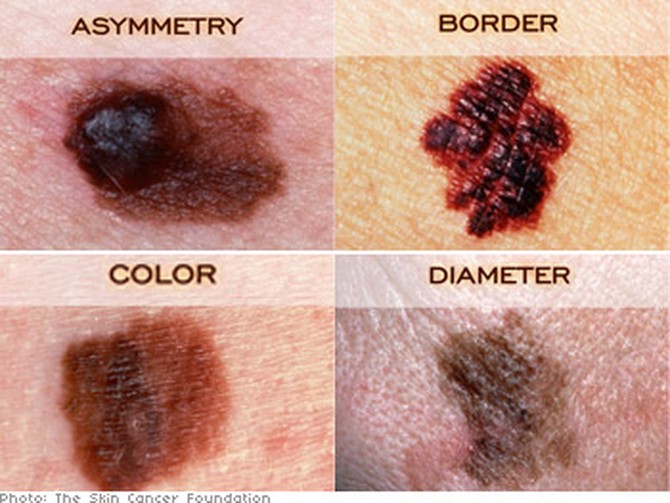 A, B, C, D of skin cancer
