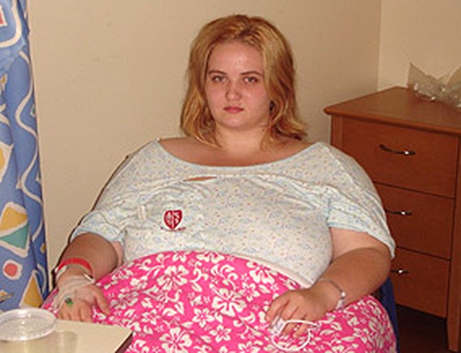Kylie decides to undergo gastric bypass surgery.
