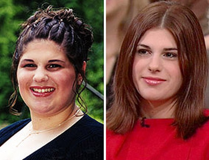 Kendall had gastric bypass surgery at age 16.