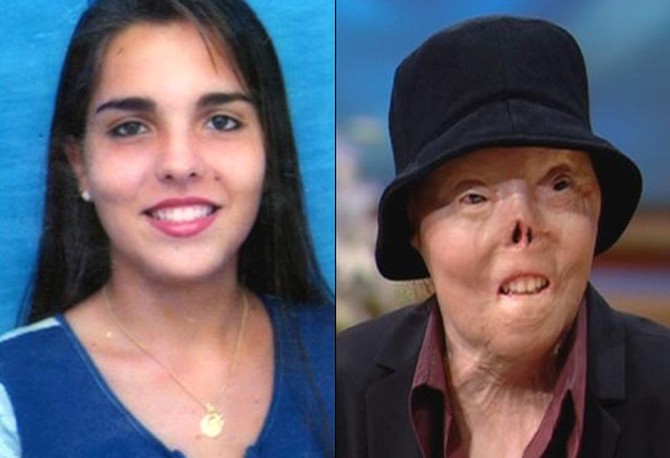 Jacqui Saburido, before and after her accident